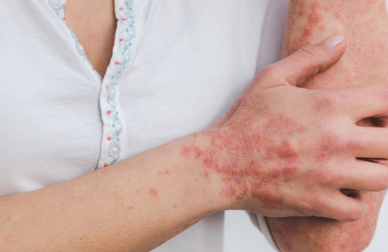 Skin disease eczema psoriasis TCM treatment Flushing NY